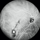 Tilted Disc Syndrome Complicated with RPE Atrophy and Polypoidal Choroidal Vasculopathy Tilted Disc Syndrome Complicated with RPE Atrophy and Polypoidal Choroidal Vasculopathy