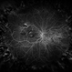 Branch Retinal Vein Occlusion Branch Retinal Vein Occlusion