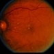 BDR / Macular Edema / Macroaneurysm BDR / Macular Edema / Macroaneurysm