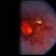 Retinal Capillary Hemangioblastoma Retinal Capillary Hemangioblastoma