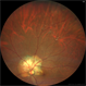 Choroidal Osteoma