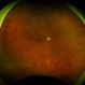 Branch Retinal Vein Occlusion