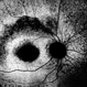 Macular Dystrophy Macular Dystrophy