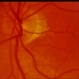 Adult Foveomacular Dystrophy / Pattern Adult Foveomacular Dystrophy / Pattern