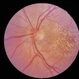 Optic Neuritis Optic Neuritis