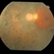 Gyrate Atrophy of Choroid and Retina