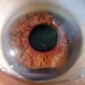 Rubeosis and Hyphema