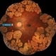 Gyrate Atrophy