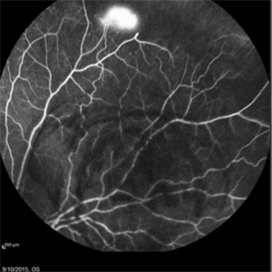 Sickle Cell Retinopathy - Retina Image Bank