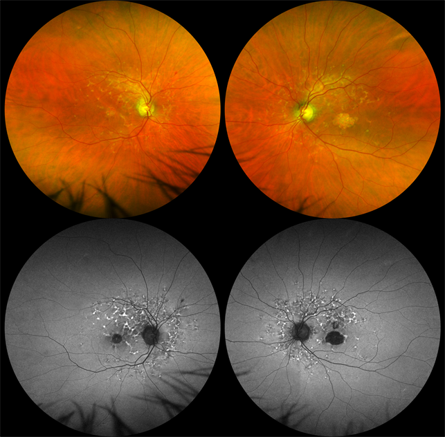 Reticular Pattern Dystrophy Retina Image Bank