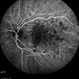 Persistent Placoid Maculopathy Persistent Placoid Maculopathy