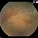 Choroidal Hemorrhage from Hypertensive  Choroidopathy