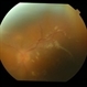 Post Injection Candida Endophthalmitis