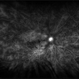 Proliferative Diabetic Retinopathy with Retinal Ischemia Proliferative Diabetic Retinopathy with Retinal Ischemia