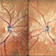 Macular dystrophy Macular dystrophy