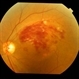 Macular Branch Vein Occlusion