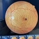 Parafoveal Telangiectasia Type 2