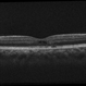 Macular Telangectasia Type 2 OCT OS Macular Telangectasia Type 2 OCT OS