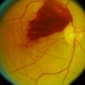 Pre-retinal haemorrhage