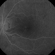 Pattern Macular Dystrophy Pattern Macular Dystrophy