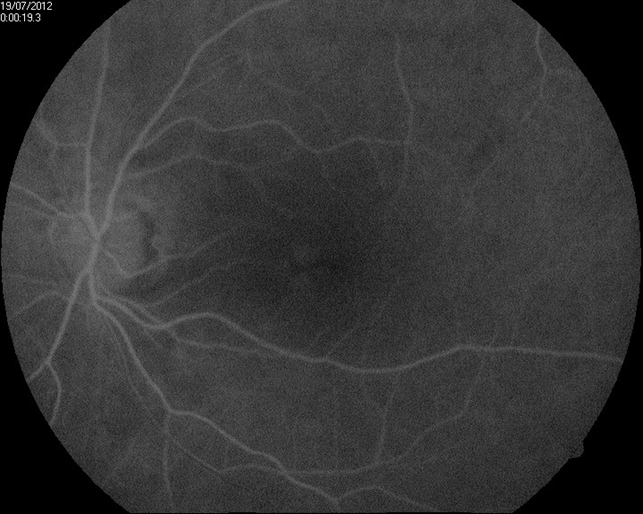 Pattern Macular Dystrophy Retina Image Bank