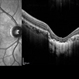 Central Areolar Choroidal Dystrophy Central Areolar Choroidal Dystrophy