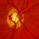 Prepapillary Vascular Loop