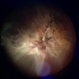 Rhegmatogenous Retinal Detachment + Proliferative Vitreoretinopathy Type C A12 Rhegmatogenous Retinal Detachment + Proliferative Vitreoretinopathy Type C A12