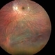 Inferior retinal detachment with lattice and holes Inferior retinal detachment with lattice and holes