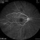 Central Retinal Artery Occlusion Central Retinal Artery Occlusion