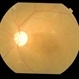 Dengue Retinitis Healed With Optic Atrophy