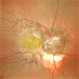 Morning glory disc anomaly-associated maculopathy:  fibroglial tissue  with a Mac-Off  serous retinal detachment. Morning glory disc anomaly-associated maculopathy:  fibroglial tissue  with a Mac-Off  serous retinal detachment.