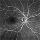 Fluorescein Angiogram of Choroidal Folds Fluorescein Angiogram of Choroidal Folds