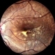 Chorio Retinital Inflammation Chorio Retinital Inflammation