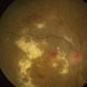 Malignant Hypertension Malignant Hypertension