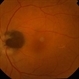 ONH-Melanocytoma ONH-Melanocytoma