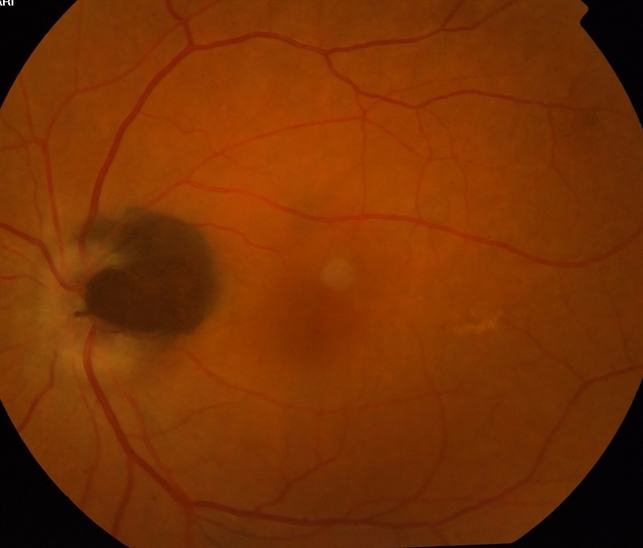 onh melanocytoma retina image