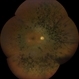 Retinitis Pigmentosa #1 Retinitis Pigmentosa #1