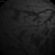 Lupus Retinopathy