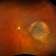 New Choroidal Melanoma New Choroidal Melanoma