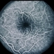 Scleritis with Chorioretinal Folds Scleritis with Chorioretinal Folds