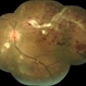 Inflammatory BRVO Inflammatory BRVO