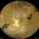 PROLIFERATIVE DIABETIC RETINOPATHY PROLIFERATIVE DIABETIC RETINOPATHY