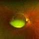 Chronic Sub-Hyaloid Hemorrhage with Dehemoglobinized Blood Chronic Sub-Hyaloid Hemorrhage with Dehemoglobinized Blood