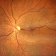 Congenital Retinal Macro Vessel Congenital Retinal Macro Vessel