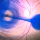 Brilliant Blue Dye Injected in a Case of Macular Hole to Stain the ILM Brilliant Blue Dye Injected in a Case of Macular Hole to Stain the ILM