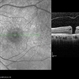 Macular Hole Macular Hole
