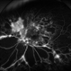 Severe Proliferative Diabetic Retinopathy
