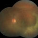 Perimacular fold in Terson's syndrome Perimacular fold in Terson's syndrome