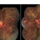 Leukemic Retinopathy Leukemic Retinopathy